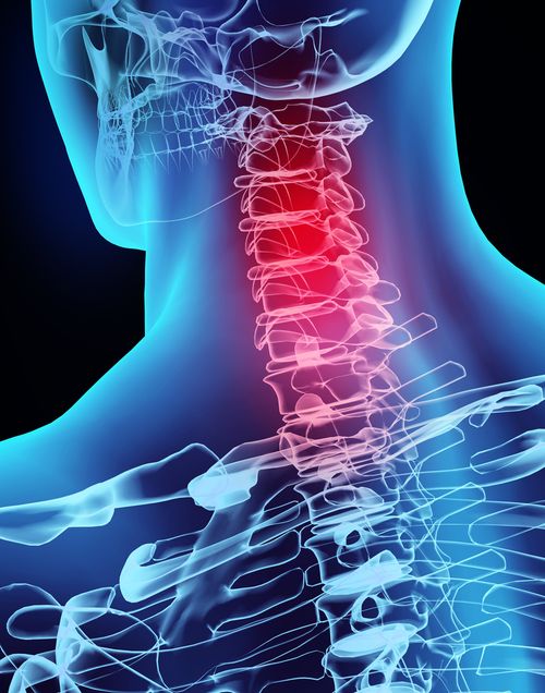 Graphic of a neck injury concept of neck injury treatments in Coconut Creek