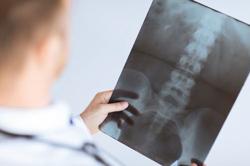 Doctor looking at x-ray, concept of Coconut Creek Spine Injury Treatment