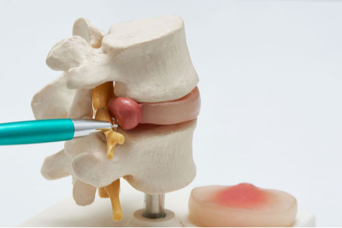 North Lauderdale herniated disc treatment concept model herniated disc