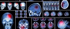 traumatic brain injuries