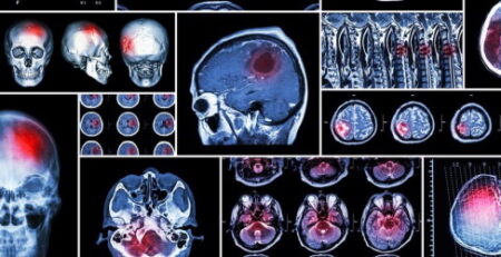 traumatic brain injuries