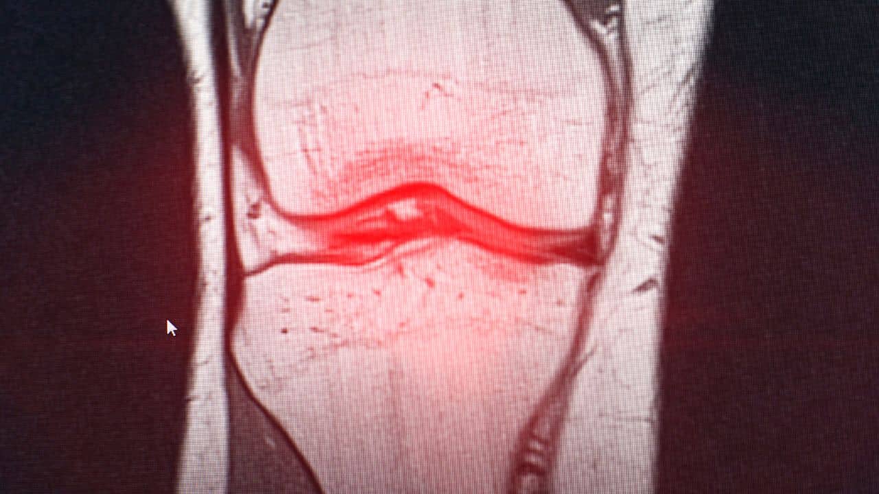 Bursitis X-ray for Bursitis Treatment