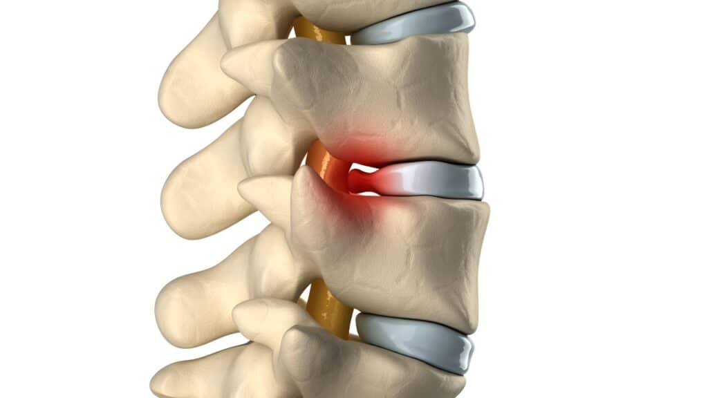 Herniated Disc